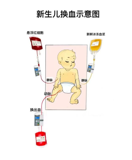 牡丹江新生儿rh溶血命悬一线哈医大一院群力紧急换血跑赢死神