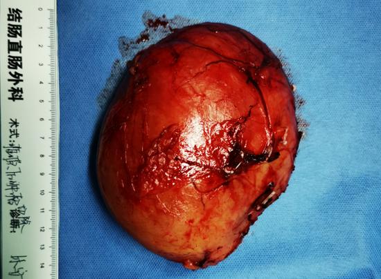 禁区排雷哈医大一院群力普外一科半月内成功切除两例罕见腹膜后肿瘤