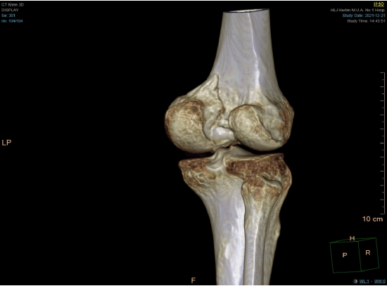 图一 术前三维ct显示股骨内侧后髁冠状位骨折
