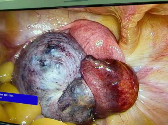 女孩卵巢囊肿蒂扭转480° 哈医大一院群力院区妇科专家应用微创技术