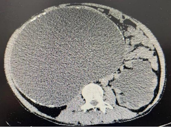 哈医大一院泌尿外科团队应用机器人辅助解除先天性肾积水50年的病痛
