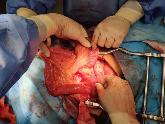 哈医大四院成功救治肠扭转老人_新浪黑龙江_新浪网