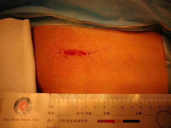 显微镜下结扎曲张精索静脉 五年不育夫妇喜得胖小子