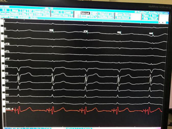 图1窦性心律心电图(记录到希氏束电位,电极已在希氏束区域)