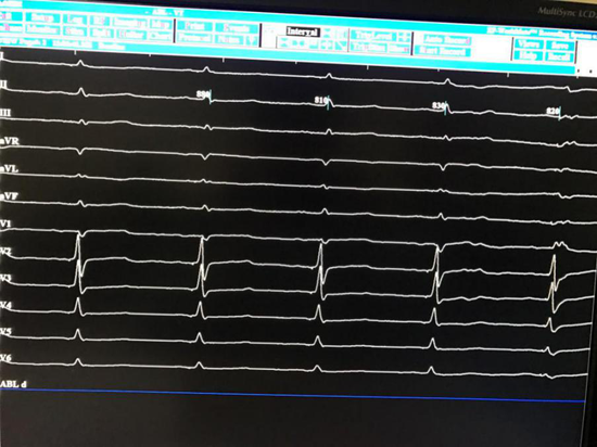 图2 希氏束起搏的心电图,与窦性心律时的形态完全一致