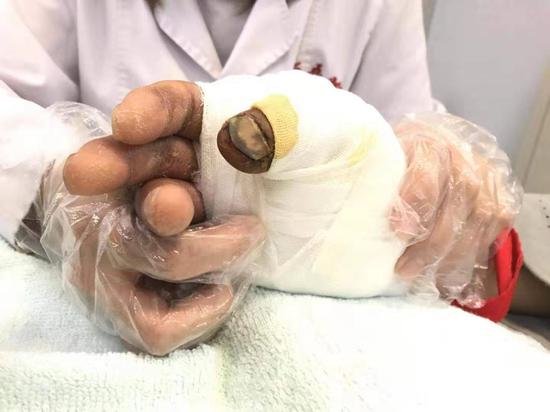 康复师为患者进行手部功能恢复性训练