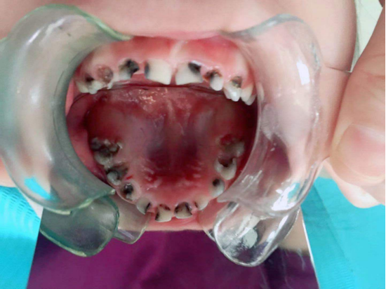 三岁幼童天天喊牙疼哈医大口腔专家提醒儿童乳牙龋齿需尽早治疗