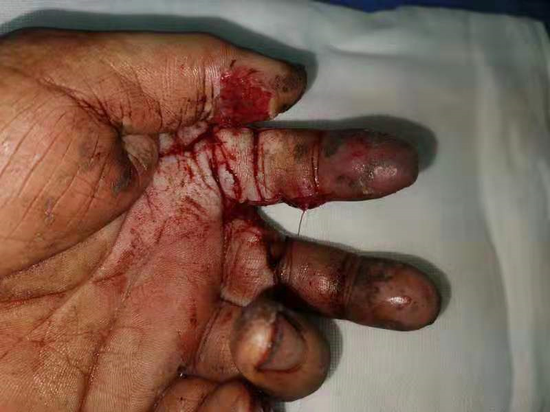 血管发育先天异常术中血管痉挛严重02哈市五院手外科