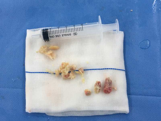 手术中取出脱出的髓核