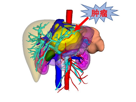 哈医大一院肝胆专家熟练应用微创技术 "拆除"肝尾状叶肿瘤