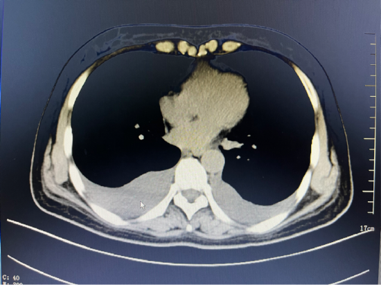 术前胸部ct示胸腔积液