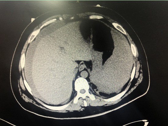ct显示大量血性腹腔积液