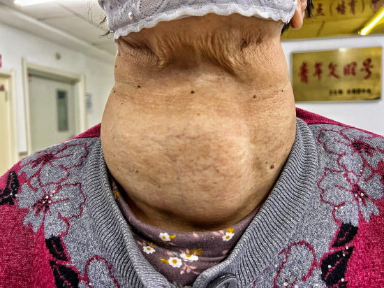哈医大一院甲状腺外科团队精准切除罕见巨大胸骨后甲状腺肿_新浪