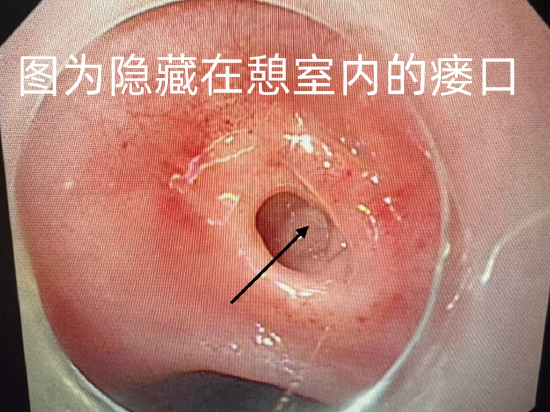 黑龙江省医院内镜下成功治愈一例罕见先天性食管支气管瘘患者