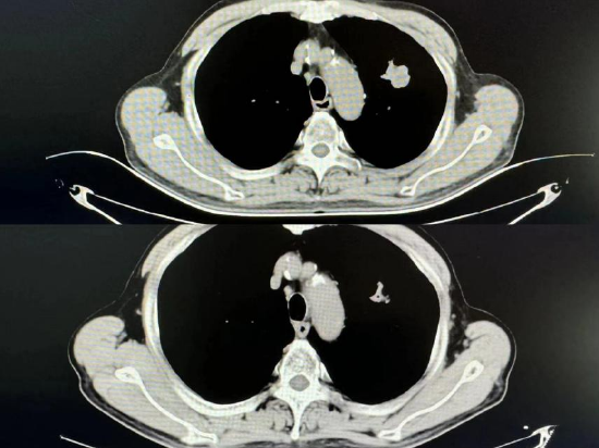 图为患者接受近距离放疗前后的肿瘤影响对比图，可见病灶明显缩小