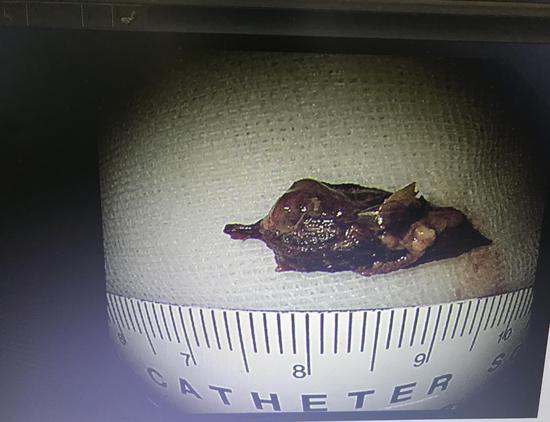 进行了食道异物取出术,一根长达两厘米,死死卡在食道壁上的枣核被成功