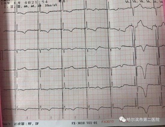 起搏器定点安装哈市二院完成希氏束起搏永久起搏器植入术