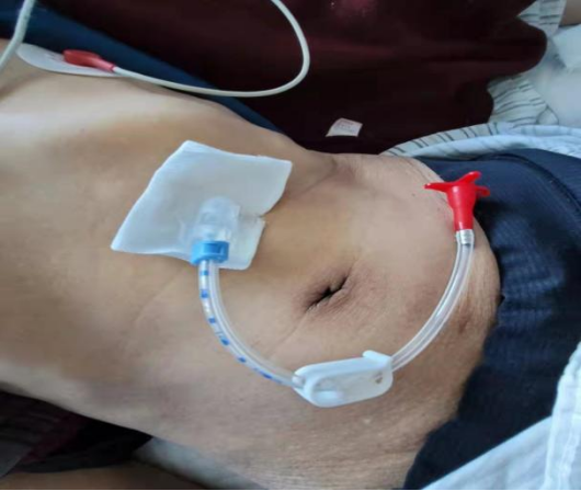 哈医大四院消化内科成功为渐冻症病人实施内镜下经皮胃造瘘术