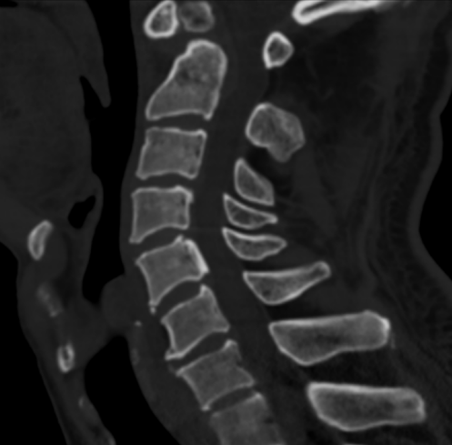 哈医大一院脊柱外科精准治疗寰枢椎脱位