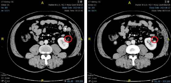 肾脏增强ct提示左肾错构瘤,红色标记处为错构瘤