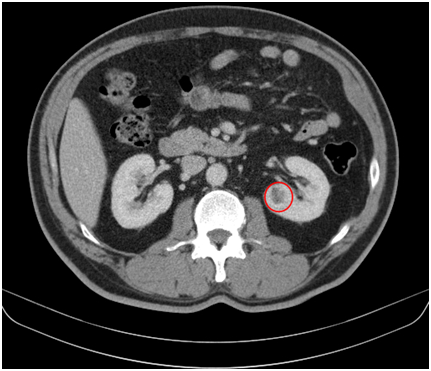 图一:肾脏增强ct提示左肾肿瘤,红色标记处即为肾肿瘤