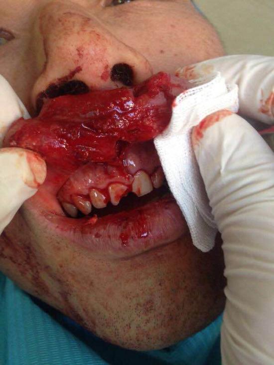 燃放爆竹把嘴炸出一个弹坑临近年关请您慎重玩鞭炮