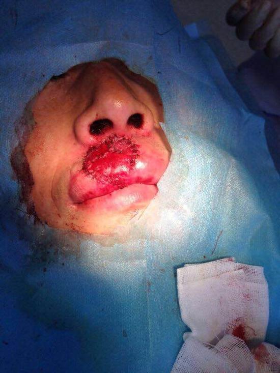 燃放爆竹把嘴炸出一个弹坑临近年关请您慎重玩鞭炮