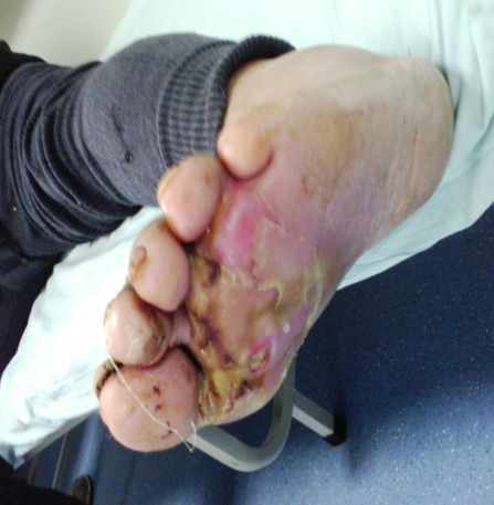 应对糖尿病列入今年世界卫生日主题哈市一院内分泌二科成功控制糖尿病