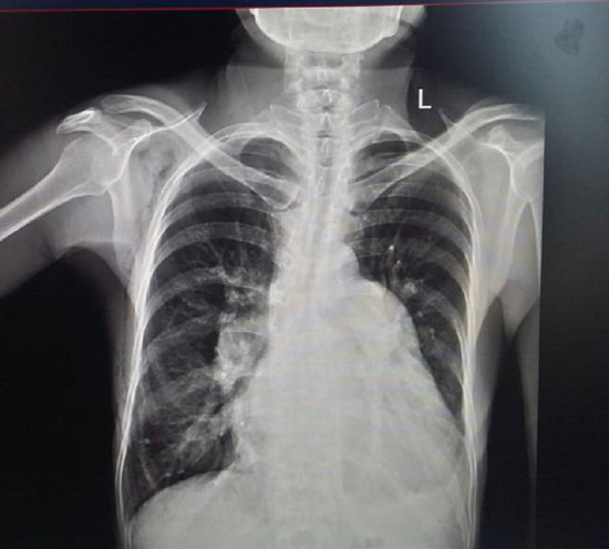 x线胸片检查显示术后右心扩大明显减小