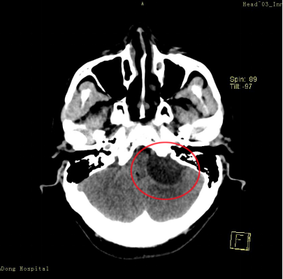 左耳听力下降原是"听神经瘤"作祟!