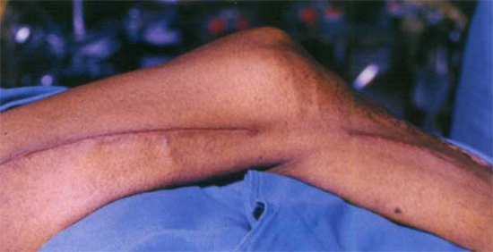 心脏外科神器八爪鱼海星助微创搭桥术远东医院胡珀元教授多次完成高难