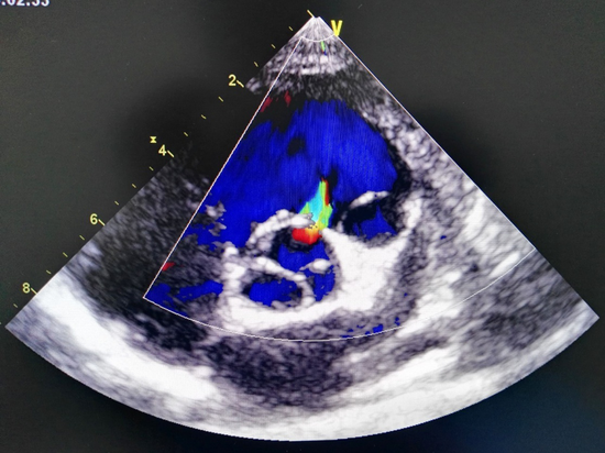 心脏彩超示室间隔缺损