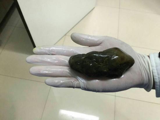 一岁小企鹅误吞巨大鹅卵石送哈医大二院救回弱小生命