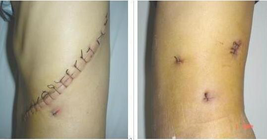 医讯告别剖腰切口远东三个小孔轻松搞定肾上腺肿物