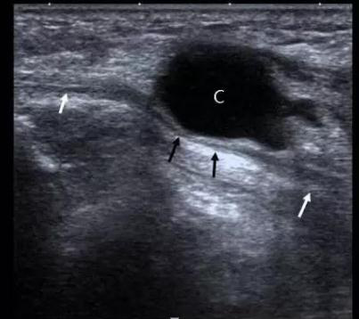 哈市一院骨八科即日起招募符合条件腱鞘囊肿患者免费治疗