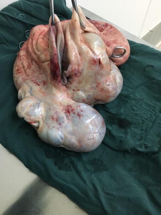 卵巢囊肿致未婚女肚大如孕妇 哈医大四院成功手术复其健康