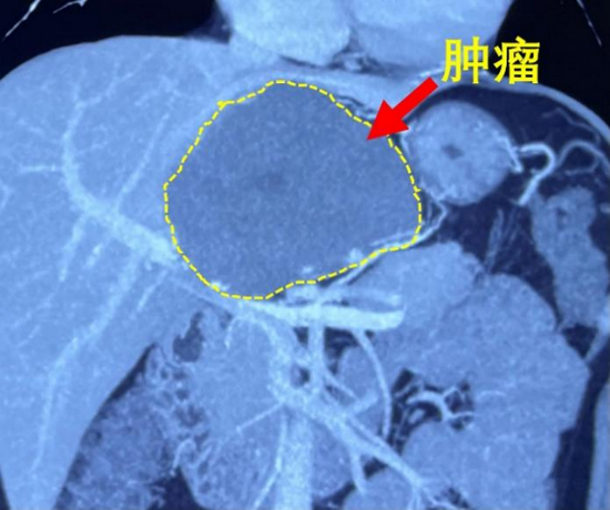 术前ct可见肝尾状叶巨大肿瘤