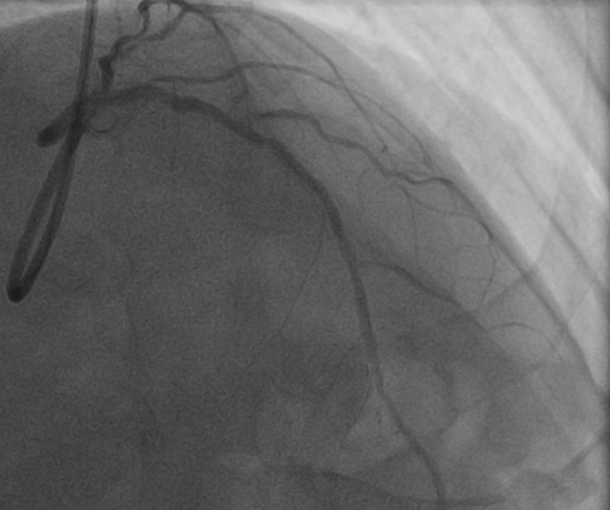 术中造影:前降支近中段2个支架通畅,近段支架内70%狭窄,中段支架内