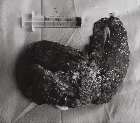 哈医大二院成功完成肝移植和肾移植手术 器官捐献让爱与生命延续