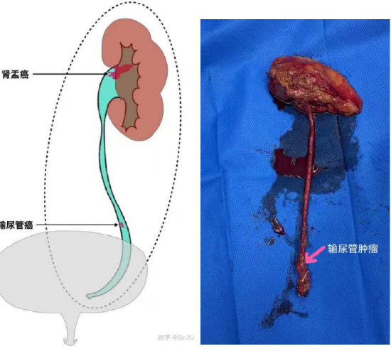 尿血非小事哈医大四院松北泌尿外科完成全腹腔镜下输尿管癌根治手术