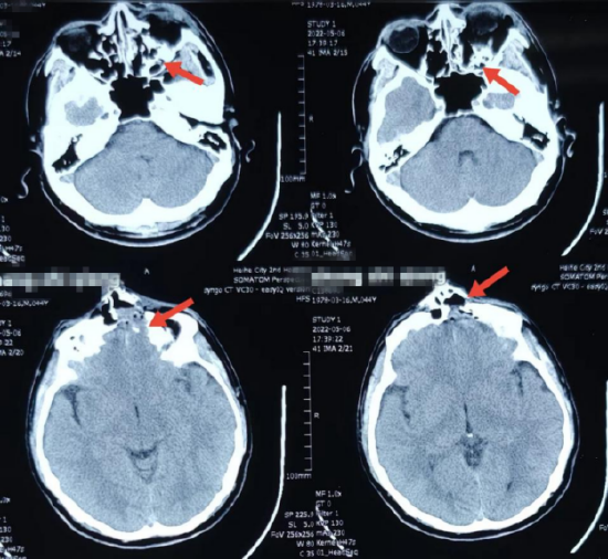 ct显示粉碎性骨折起始于前额及鼻根,沿着颅底及眼眶顶壁,一直延伸至