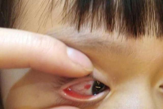 皓皓眼睛意外受伤 邹市明心疼:要多保护自己