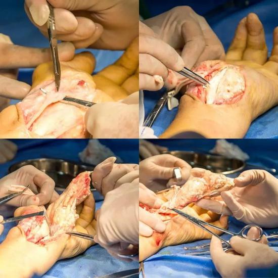 哈医大鸿森医院顺利完成巨大痛风石切除手术