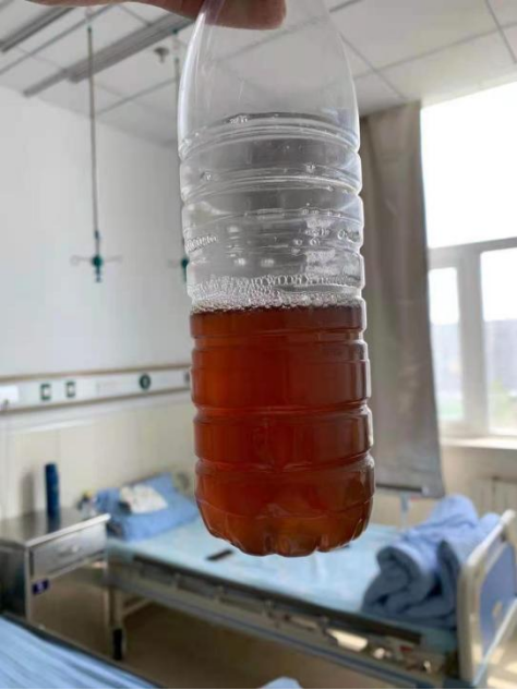 尿血么哈医大一院群力院区小儿内科联合彩超室治疗严重血尿蛋白尿患儿