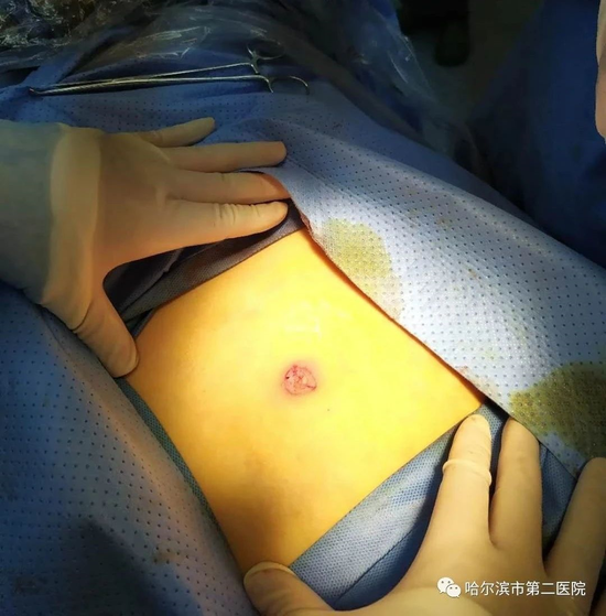 脐部藏乾坤微创不留痕哈尔滨市第二医院成功完成高难度经脐单孔腹腔镜
