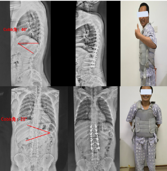 胸椎侧后凸畸形vcr截骨矫形手术帮助35岁小伙挺起脊梁_新浪黑龙江