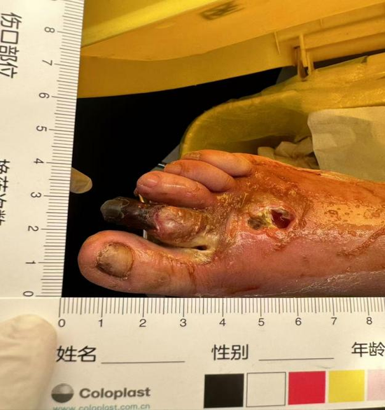 患者入院第一天患处照片(伴有干性坏疽合并窦道感染)