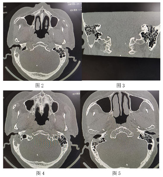 哈医大四院耳鼻喉科治愈先天性中耳胆脂瘤患者1例