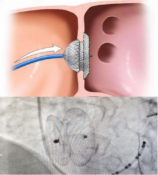哈医大一院多学科联合一次入路完成经导管射频消融术 经皮房间隔缺损