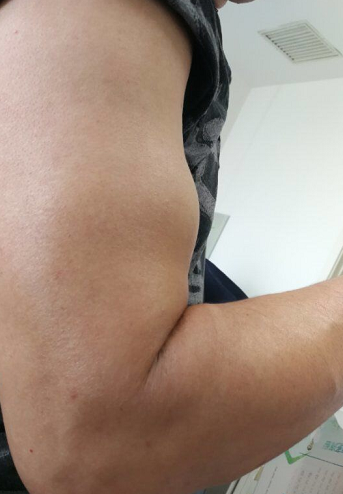 哈市五院运动医学科男子右臂忽然壮硕起来原来是大力水手症